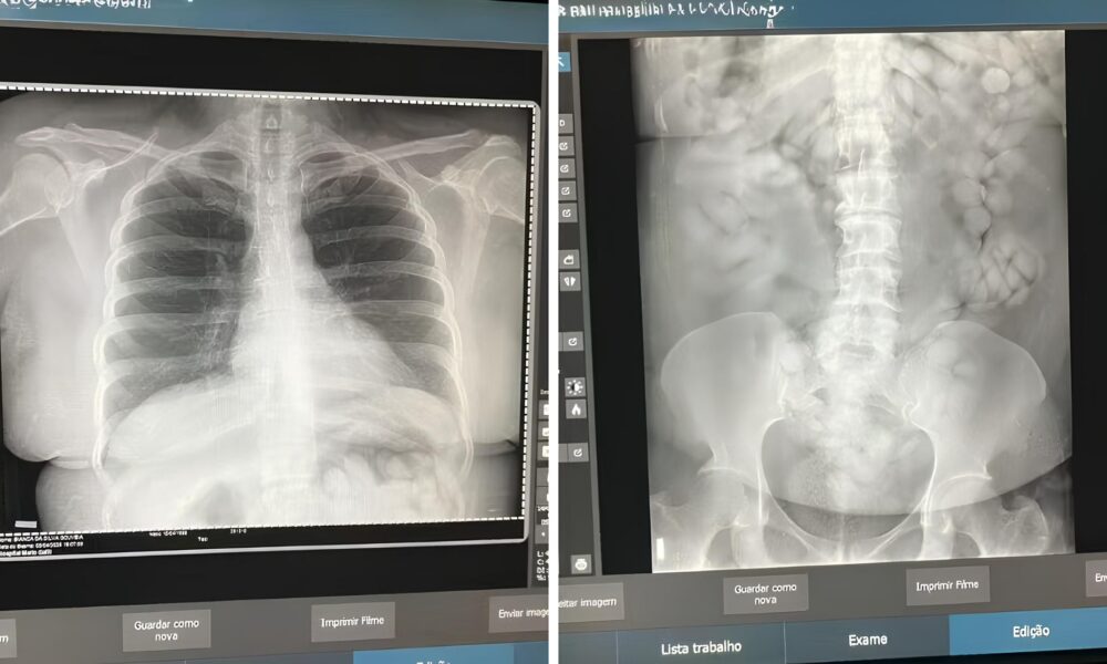 100 C psulas de Coca na no Corpo A Hist ria Por Tr s da Pris o que Abalou Viracopos