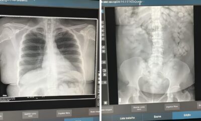 100 C psulas de Coca na no Corpo A Hist ria Por Tr s da Pris o que Abalou Viracopos