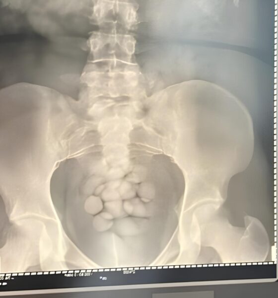 A Operação Shield e a Mulher que Engoliu 100 Cápsulas de Cocaína: Um Caso que Abalou Viracopos 16 A Opera o Shield e a Mulher que Engoliu 100 C psulas de Coca na Um Caso que Abalou Viracopos