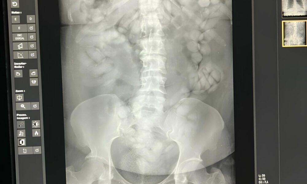 Mulher Engole 100 C psulas de Coca na e Presa em Viracopos A Hist ria N o Contada do Crime Internacional