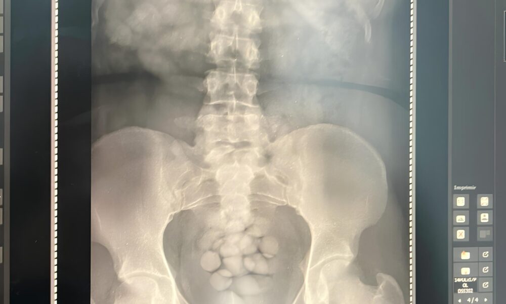 O Est mago Virou Mala A Hist ria de uma Mulher Presa com 100 C psulas de Coca na no Aeroporto de Viracopos