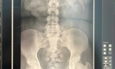 O Est mago Virou Mala A Hist ria de uma Mulher Presa com 100 C psulas de Coca na no Aeroporto de Viracopos