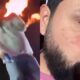 L o do Sertanejo L o Raphael O Dia em que o Palco Virou um Inferno Como Ele Est Recuperando Sua Vida Ap s Queimaduras Graves